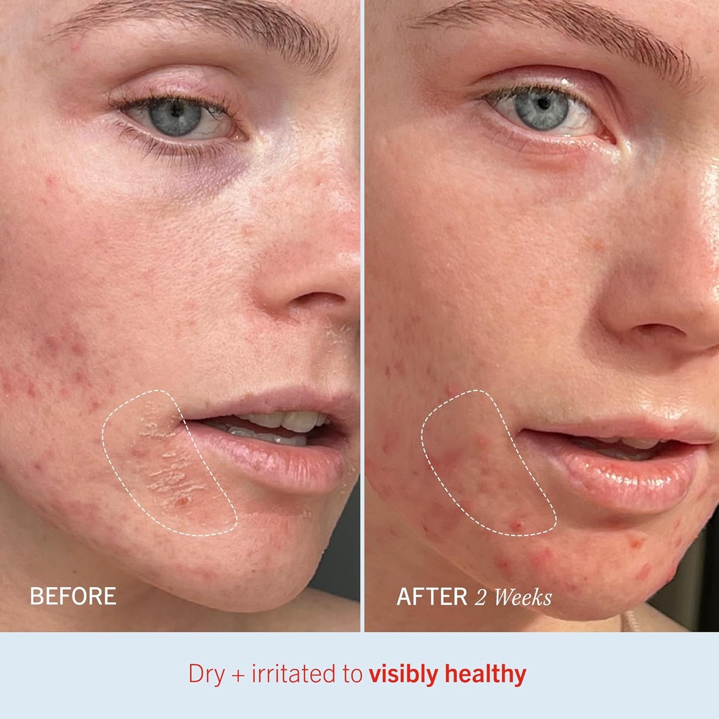 First Aid Beauty Ultra Repair Cream, 56.7 g (2 oz) [12M]
